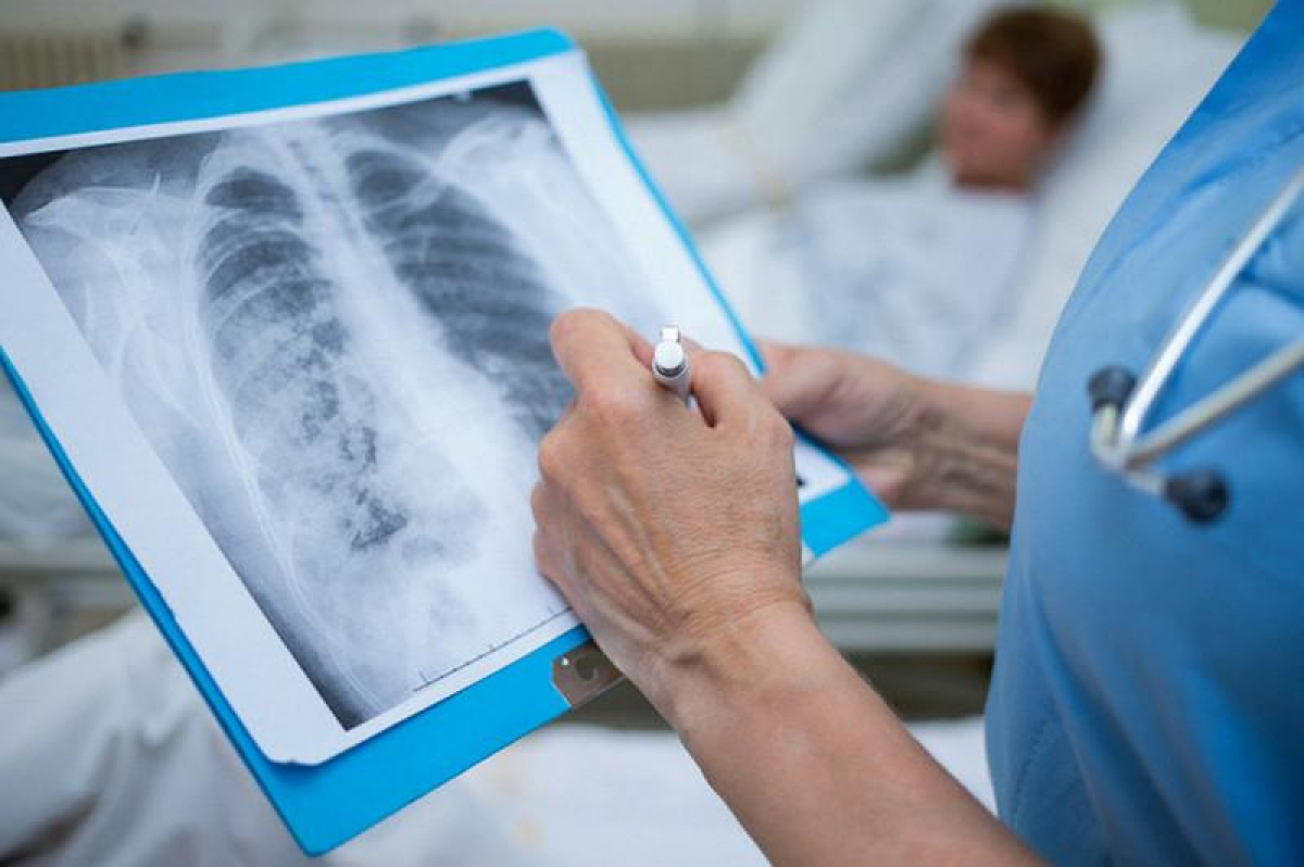 Пневмонія: 4 головні помилки у лікуванні