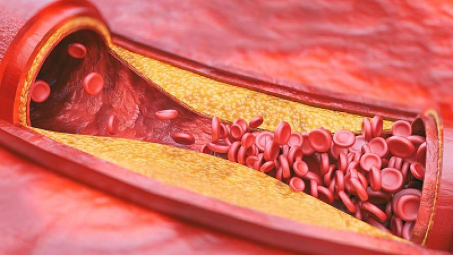 Високий рівень холестерину