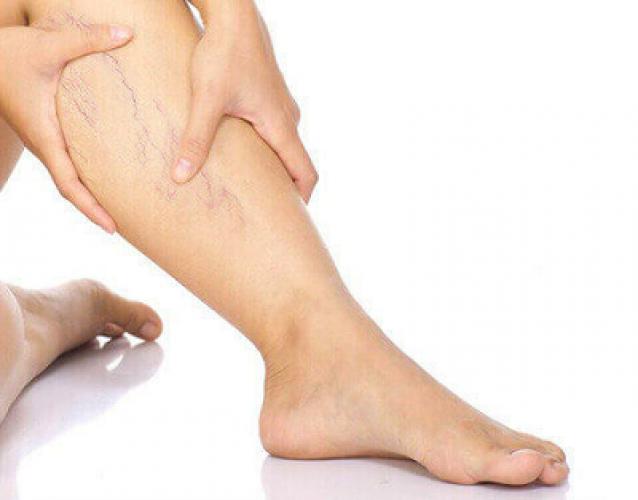 Варикозне розширення вен: причини, симптоми та лікування.