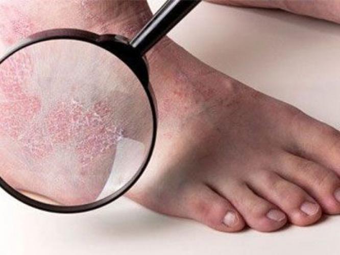 Сухість шкіри.