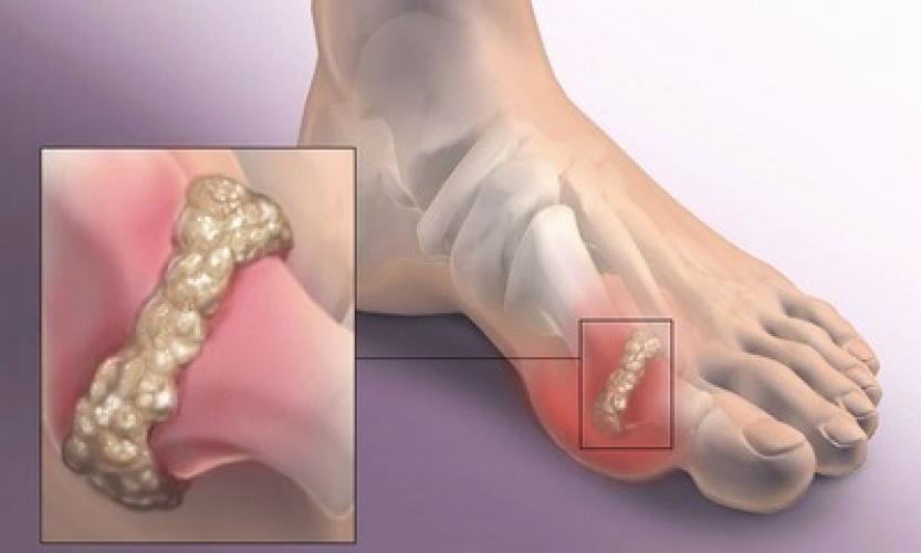 Подагра. Все що ми знаємо про подагру.